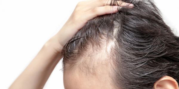Perder el cabello también duele por dentro: el lado emocional de la alopecia